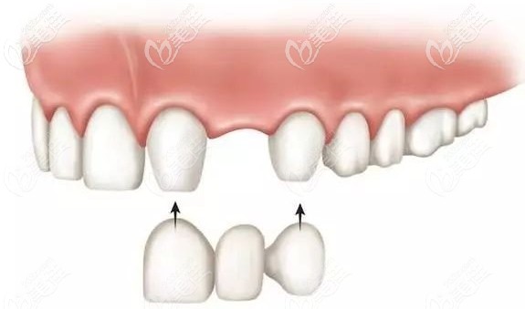 齊佳妮醫(yī)生擅長多種鑲牙技術(shù) 齊佳妮醫(yī)生擅長多種鑲牙技術(shù)