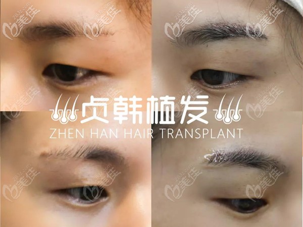 眉毛稀淡、缺眉、斷眉怎么辦?這有南寧貞韓植眉后眉毛后真實圖片給你借鑒