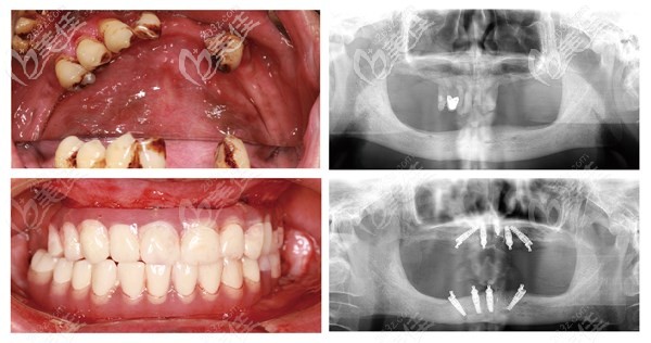 杭州六旬老人種植全口牙的真實案例,用的是以色列科特斯種植體系統(tǒng)