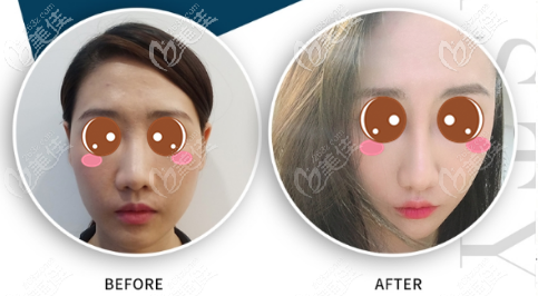 耳骨墊鼻尖多久鼻頭能軟？我做的鼻綜合用了28天