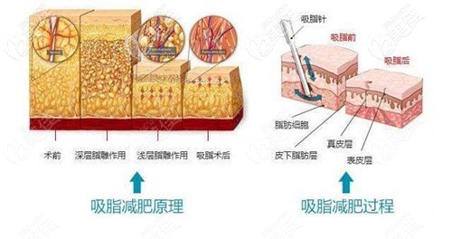 楊柳醫(yī)生吸脂技術(shù)