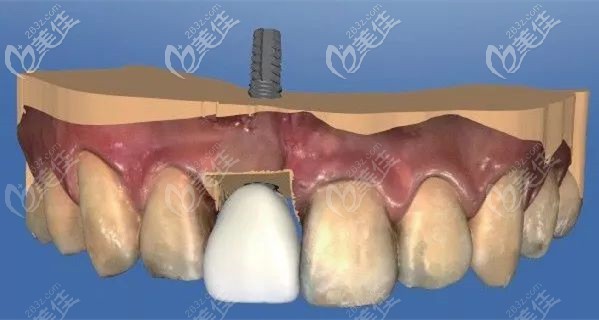 前牙美學(xué)種植示意圖