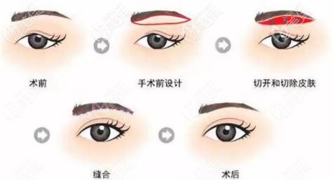 沈陽(yáng)杏林王貴雄做提眉術(shù)好不好