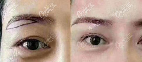 杏林王貴雄提眉術(shù)真人前后對(duì)比照