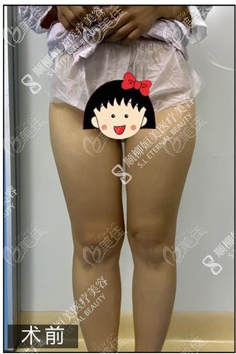 大腿抽脂手術(shù)前 大腿抽脂手術(shù)前