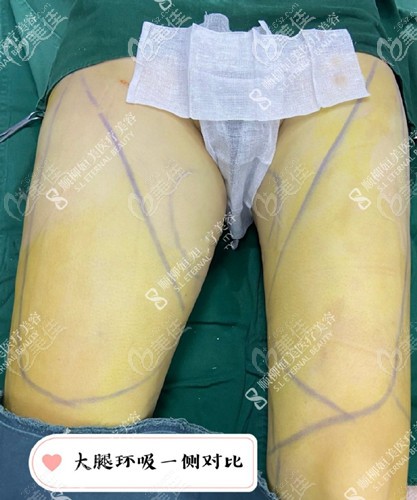 大腿環(huán)吸手術(shù)過程 大腿環(huán)吸手術(shù)過程