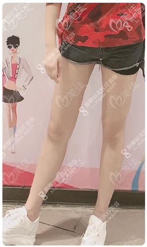 給我做大腿環(huán)吸抽脂1500ml后腿圍瘦了7厘米呢