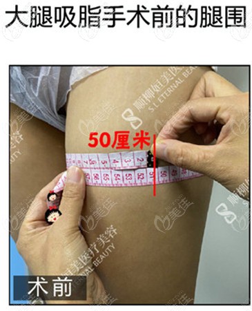 抽脂錢腿圍50厘米 抽脂錢腿圍50厘米