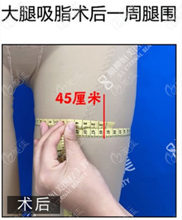 抽脂后腿圍45厘米 抽脂后腿圍45厘米