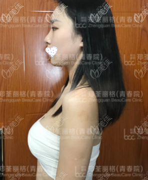 自體脂肪隆胸術(shù)后7天效果圖