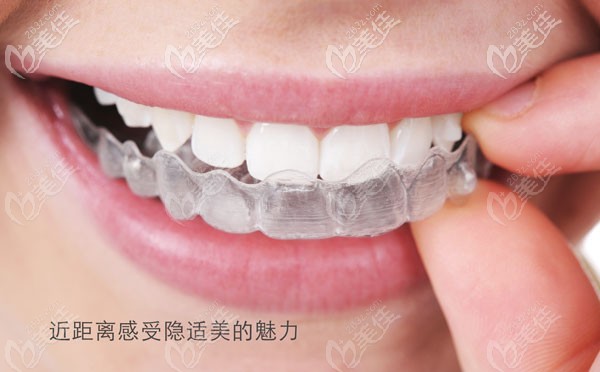 長(zhǎng)春環(huán)球口腔的隱適美牙套圖 長(zhǎng)春環(huán)球口腔的隱適美牙套圖