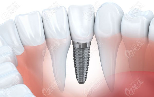 這是環(huán)球口腔的牙齒種植價(jià)位 這是環(huán)球口腔的牙齒種植價(jià)位