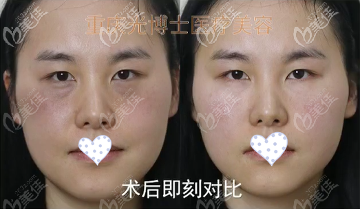 嗨體熊貓針去淚溝效果圖 嗨體熊貓針去淚溝效果圖