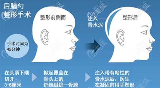 骨水泥填充后腦勺效果及手術(shù)步驟 骨水泥填充后腦勺效果及手術(shù)步驟