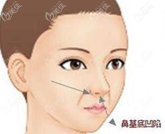鼻基底凹陷示意圖
