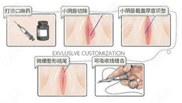 小陰唇手術過程圖解