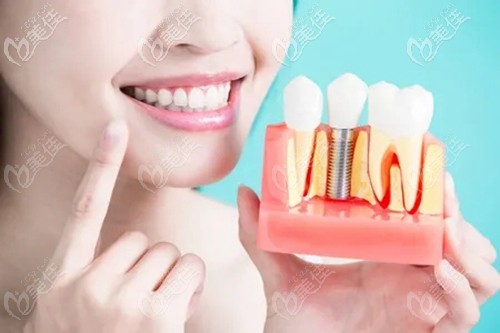 <!--<i data=20240703-sp></i>-->種植牙優(yōu)惠