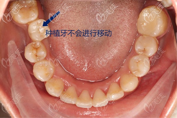 缺牙和牙齒不齊的情況下，建議先矯正后種植