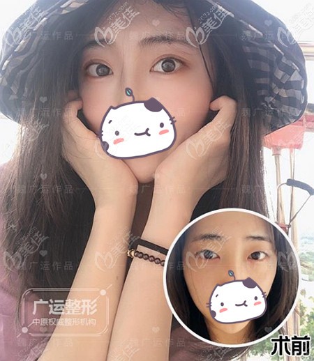 別再問(wèn)我鄭州醫(yī)生割雙眼皮怎么樣了，直接看我做全切后的效果吧！