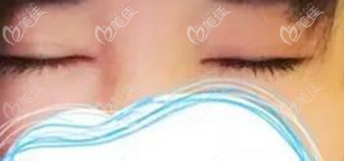 全切雙眼皮恢復(fù)后幾乎沒有什么疤痕 全切雙眼皮恢復(fù)后幾乎沒有什么疤痕