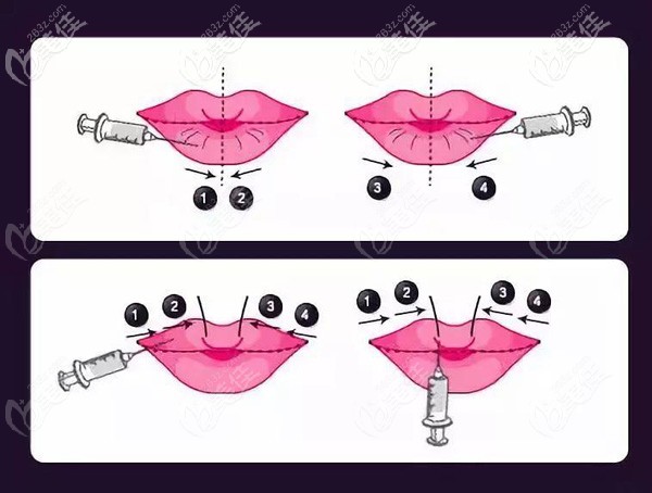 內(nèi)部資料：去合肥斯爾美做M唇手術(shù)的術(shù)前術(shù)后即刻對比照，想了解的快來看