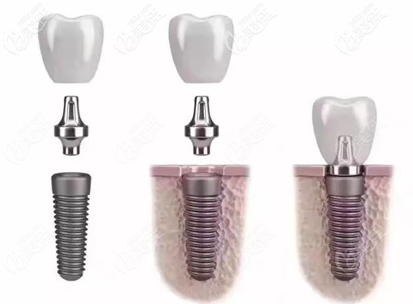 種植體常用的材料主要是純鈦及鈦合金 種植體常用的材料主要是純鈦及鈦合金