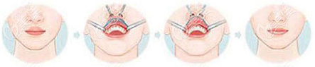 厚唇改薄手術(shù)過程示意圖 厚唇改薄手術(shù)過程示意圖
