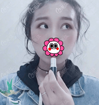 做完全切雙眼皮1個(gè)多月