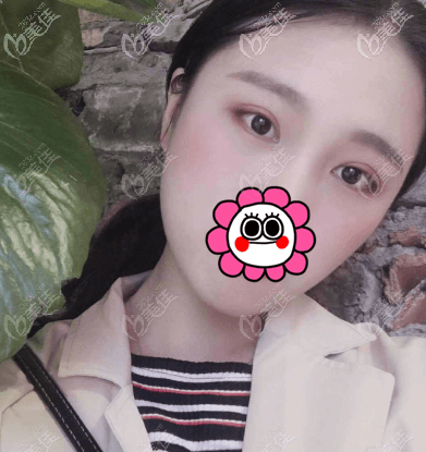 在北京童仁做完全切雙眼皮手術(shù)到現(xiàn)在,沒(méi)有出現(xiàn)越來(lái)越窄的情況