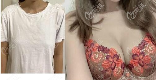 美國曼托尊貴版毛面水滴形假體隆胸效果對比圖 美國曼托尊貴版毛面水滴形假體隆胸效果對比圖