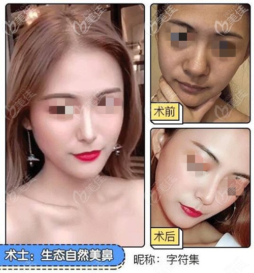 趙棟材自體肋軟骨隆鼻案例