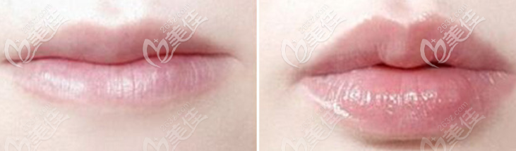 自體脂肪豐唇效果圖參考 自體脂肪豐唇效果圖參考