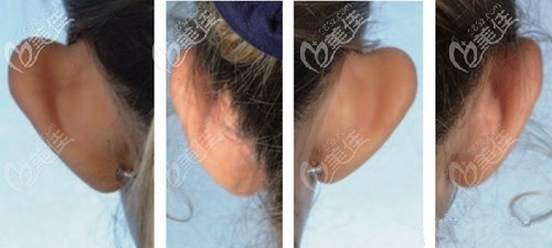 余文林醫(yī)生招風耳矯正案例