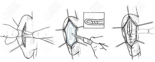 余文林招風耳矯正手術