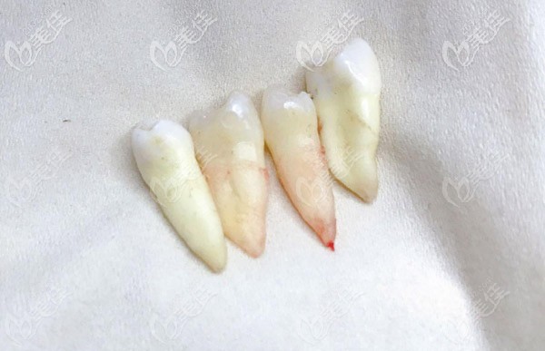 這是我后來(lái)拔掉的4顆4號(hào)牙