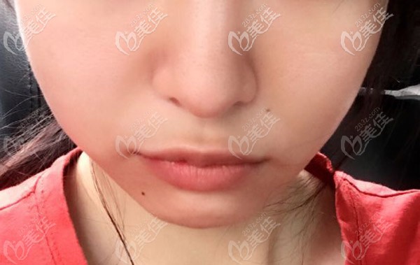 這是拔完牙后的照片，臉腫的像個(gè)豬頭