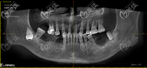 陳先生在泉州維樂(lè)口腔做種植牙前CT 陳先生在泉州維樂(lè)口腔做種植牙前CT