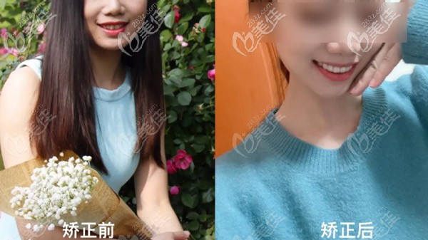 想知道拔了8顆牙齒后戴時(shí)代天使是什么感受？拔牙矯正前后對(duì)比圖來(lái)嘍