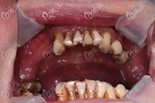 陳先生在泉州維樂(lè)口腔做種植牙照片 陳先生在泉州維樂(lè)口腔做種植牙照片