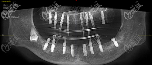 陳先生在泉州維樂(lè)口腔做種植牙術(shù)后CT 陳先生在泉州維樂(lè)口腔做種植牙術(shù)后CT