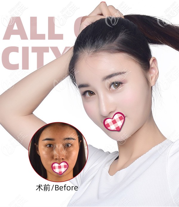 成都恒博天姿自體脂肪面部填充案例效果