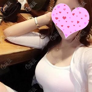 聶志宏醫(yī)生為我做假體隆胸手術(shù)效果