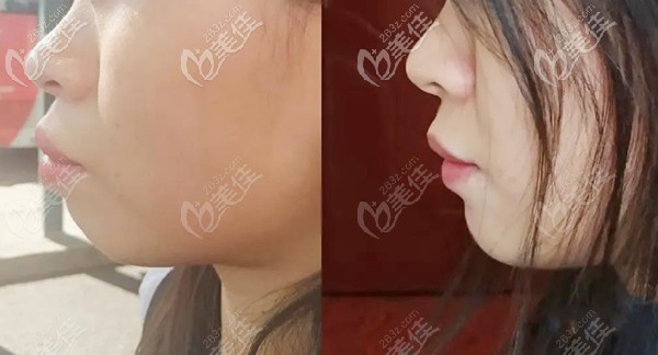 寶媽矯正前后的唇部形態(tài)對比圖 寶媽矯正前后的唇部形態(tài)對比圖