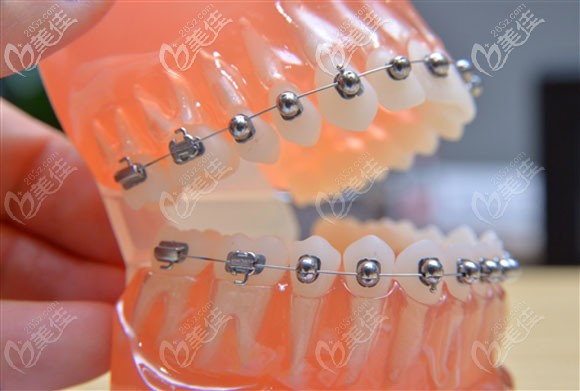 寶媽現(xiàn)身忠告:在長(zhǎng)春環(huán)球口腔戴牙套矯正的真實(shí)經(jīng)歷+價(jià)格+醫(yī)生+技術(shù)評(píng)價(jià)分享！