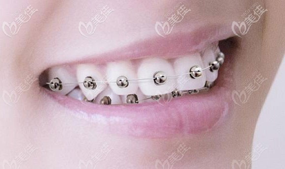 球形自鎖牙套佩戴圖 球形自鎖牙套佩戴圖