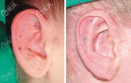 廣州高尚余文林招風(fēng)耳矯正案例 廣州高尚余文林招風(fēng)耳矯正案例