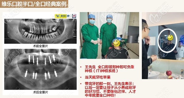 泉州維樂ITI全口即刻負重種植案例