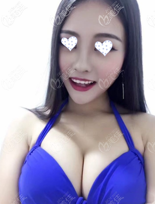 你自己看傲諾拉璀璨水滴假體250cc/290cc效果圖，胸大了3個(gè)罩杯