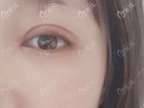 雙眼皮術(shù)后7天到醫(yī)院拆線