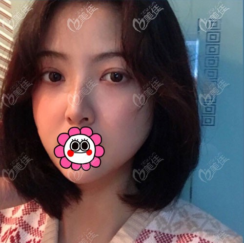 如果不知道哈爾濱丹做雙眼皮好不好，就從眼綜合案例中尋找答案吧